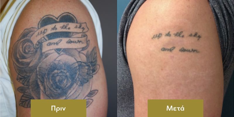 Αφαιρεση Τατουαζ στο Μπρατσο Πριν και Μετα