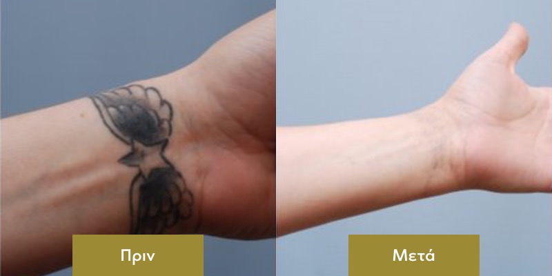 Αφαιρεση Τατουαζ Πριν και Μετα