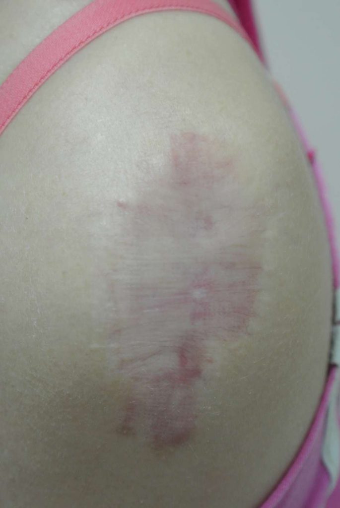 Keloids, Hypertrophic and Atrophic Scars | Dermatology Clinic Dermadvance