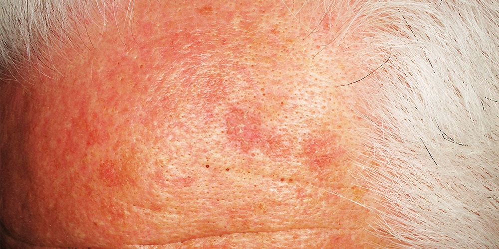 actinic keratosis face