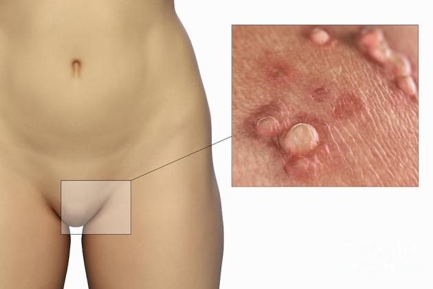 vaginal warts