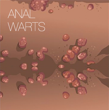 Treatment Anal Warts