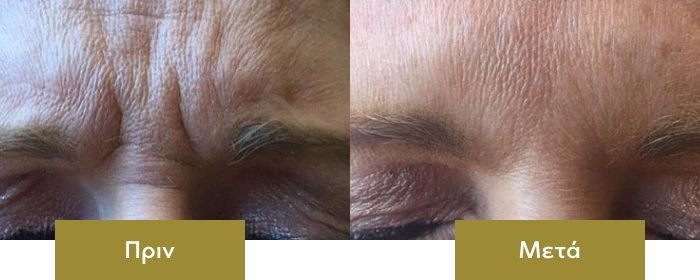 botox-before-after-01 botox-before-after-01