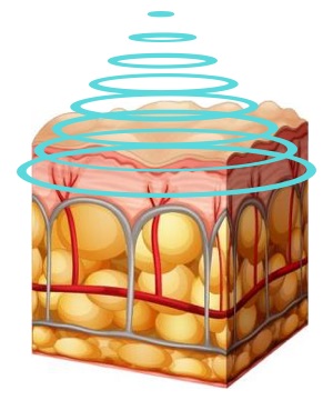 Cavitation Εφαρμογη