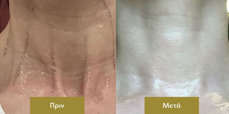 Ultherapy στο Λαιμο Πριν και Μετα