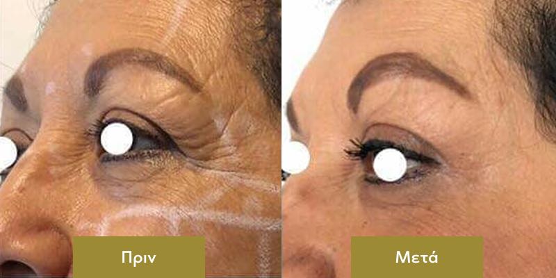 Ultherapy στο Προσωπο Πριν και Μετα