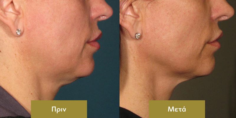 Ultherapy Αποτελεσματα