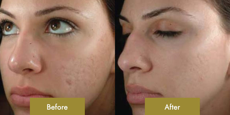 acne-scars-before-after-01-en.jpg