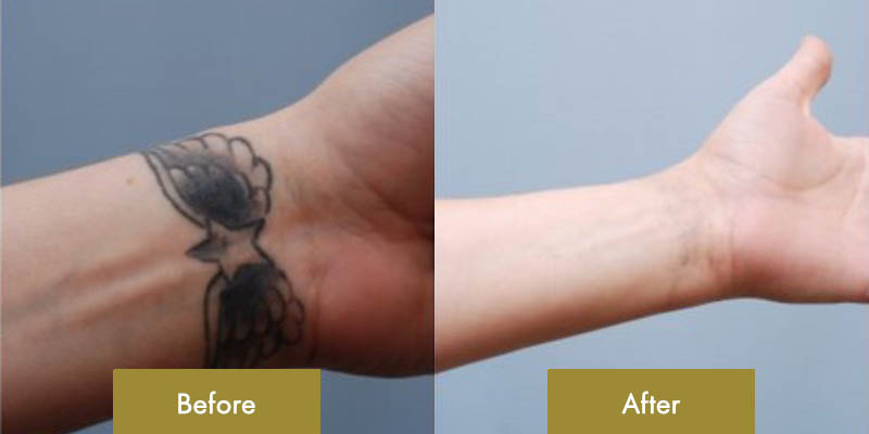 TATTOO REMOVAL  DERMAPROGR