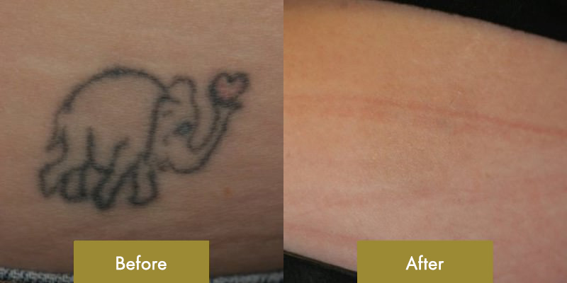 Regretting that permanent tattoo? Say goodbye to embarrassment at Dr.  Gautam Rekhi Skin Hair & Laser Clinic! Our pain-free tattoo removal... |  Instagram
